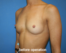 plastic-surgery-breast-augmentation